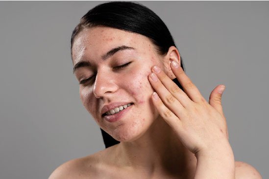 acne treatment in bangalore​